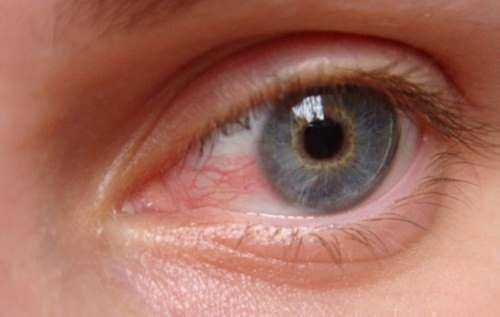 Червоні очі: як позбутися почервоніння за допомогою простих домашніх засобів - INFBusiness