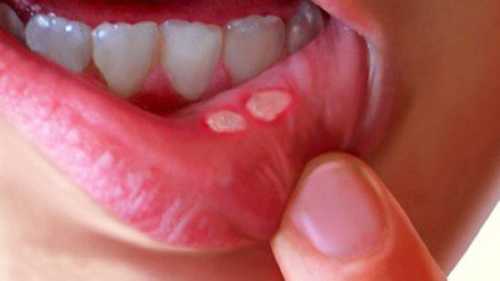 7 натуральних ліків, що допоможуь позбутись язв у роті - INFBusiness