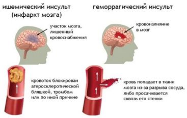 У разі інсульту врятує життя звичайна ГОЛКА! Це потрібно знати всім! - INFBusiness