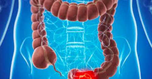 Вчені назвали важливі ранні симптоми раку прямої кишки - INFBusiness